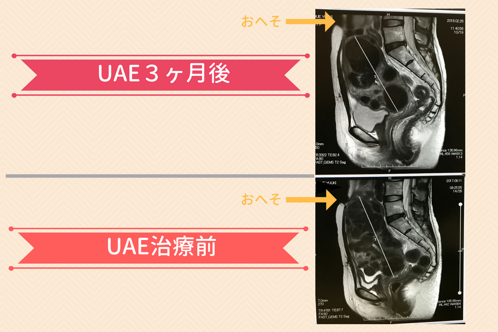 UAE後のMRI検査の結果